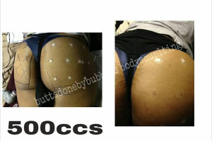 pigułki BBB zastrzyki, PMMA hydrożelu pośladki tyłek INIEKCJI zestaw