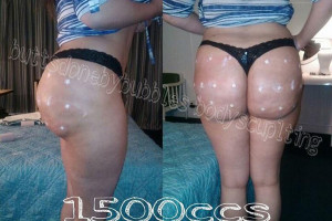 pigułki BBB zastrzyki, PMMA hydrożelu pośladki tyłek INIEKCJI zestaw