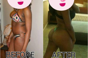 pigułki BBB zastrzyki, PMMA hydrożelu pośladki tyłek INIEKCJI zestaw