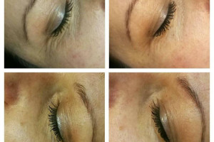 Mezoterapia Iglowa ,Wypelniacze oraz lipoliza iniekcyjna