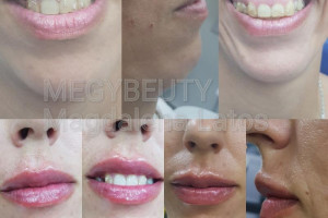 Gabinet Medycyny estetycznej, BOTOX, PRP, Wypełniacze, Leczenie łysienia androgenowego i przebrawień na skórze.