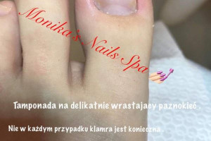 PAZNOKCIE ! PRZEDŁUŻENIE, UZUPEŁNIENIE, REKONSTRUKCJA, KLAMRA NA WRASTAJĄCE PAZNOKCIE.