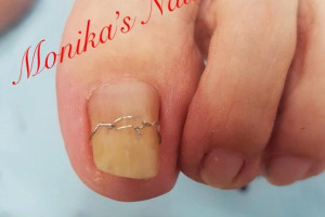 PAZNOKCIE ! PRZEDŁUŻENIE, UZUPEŁNIENIE, REKONSTRUKCJA, KLAMRA NA WRASTAJĄCE PAZNOKCIE.