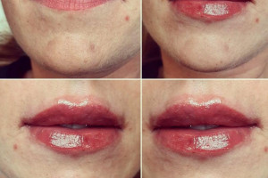 Zbieram zapisy na wypełnianie ust kwasem hialuronowym